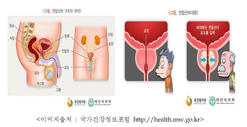 소변 약해지면 '전립선 비대증' 의심…환자 92%가 50대 이상 - 1