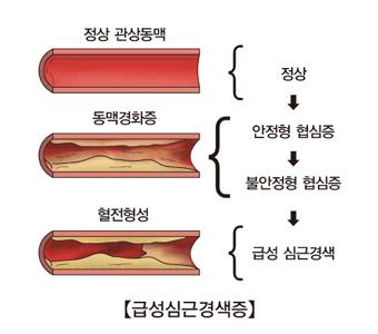 심장마비 경보