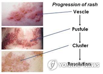 VZV 유발 대상포진 단계별 증상 