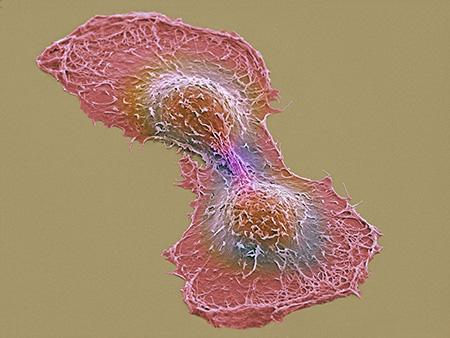 암세포 두 개의 전자현미경 영상 이미지