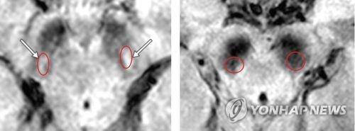 렘수면행동장애 환자의 뇌 MRI 영상. 오른쪽은 파킨슨병이 예상되는 경우. 