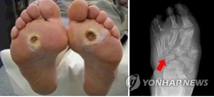 당뇨병성 족부궤양
