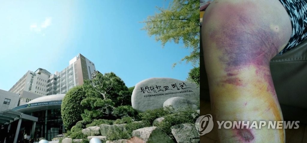 부산대학교병원 전경과 지도교수 폭행으로 피멍든 전공의 다리