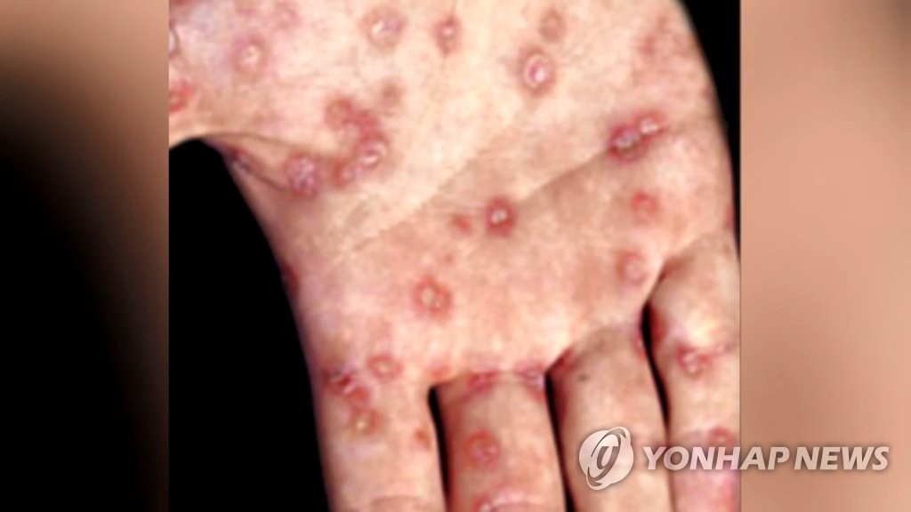 매독
