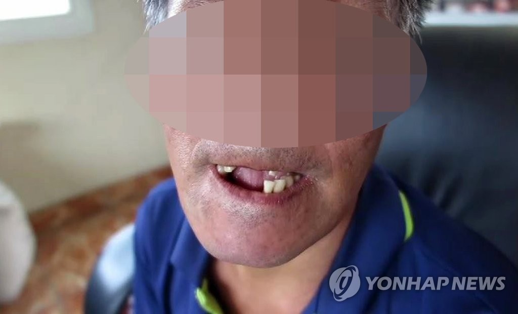 치아 거의 빠진 노동착취 장애인