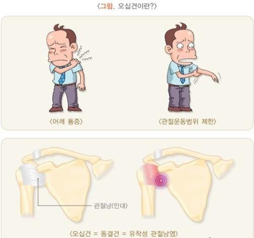 오십견