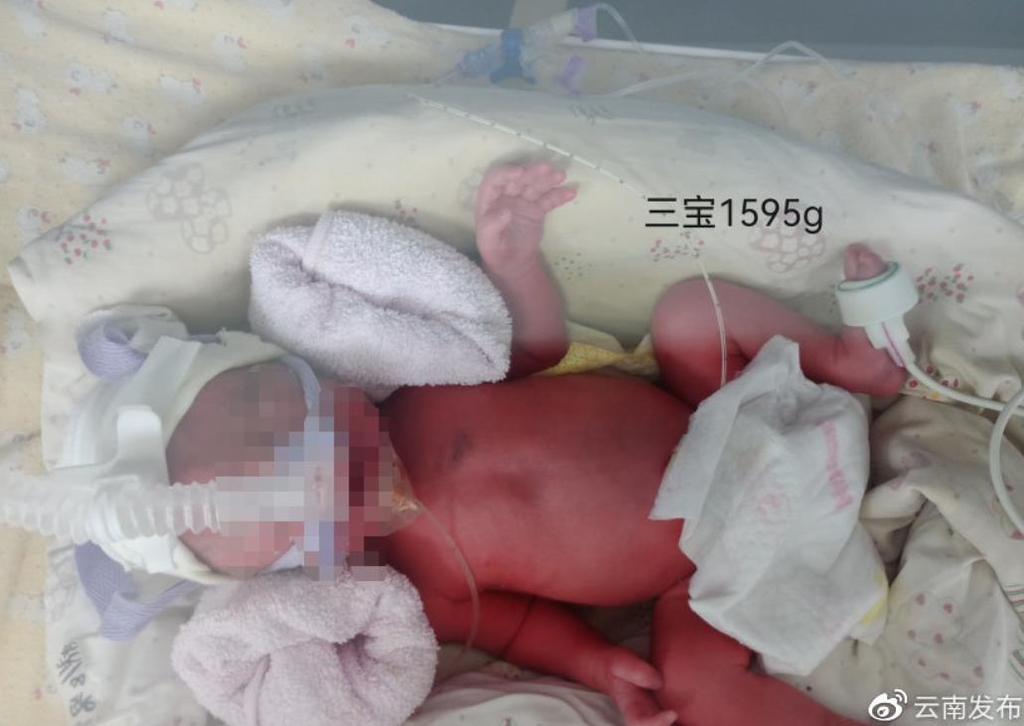중국서 코로나 걸린 임산부, 세쌍둥이 무사히 출산
