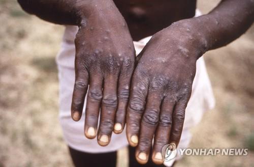 1997년 콩코민주공화국에서 촬영한 원숭이두창 환자의 손