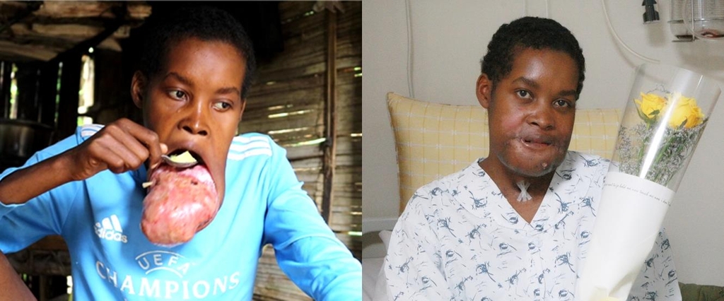 '징그러운 혹이 달린 아이'라며 놀림을 받던 아프리카 남동쪽 섬나라 마다가스카르 오지의 청년 플란지의 수술 전(왼쪽, 올해 5월)과 수술 후(오른쪽) 비교 사진. [서울아산병원 제공]