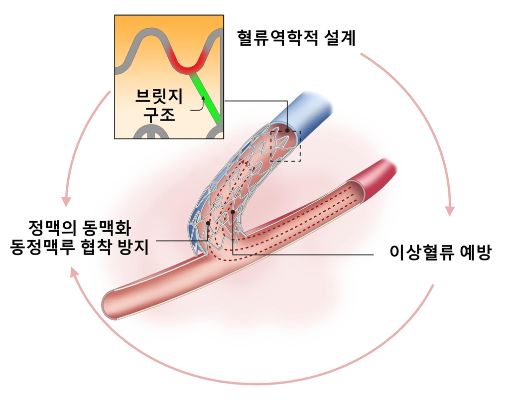 새로 개발한 투석혈관 조성술에서 혈관 협착을 막을 수 있는 혈관 지지체