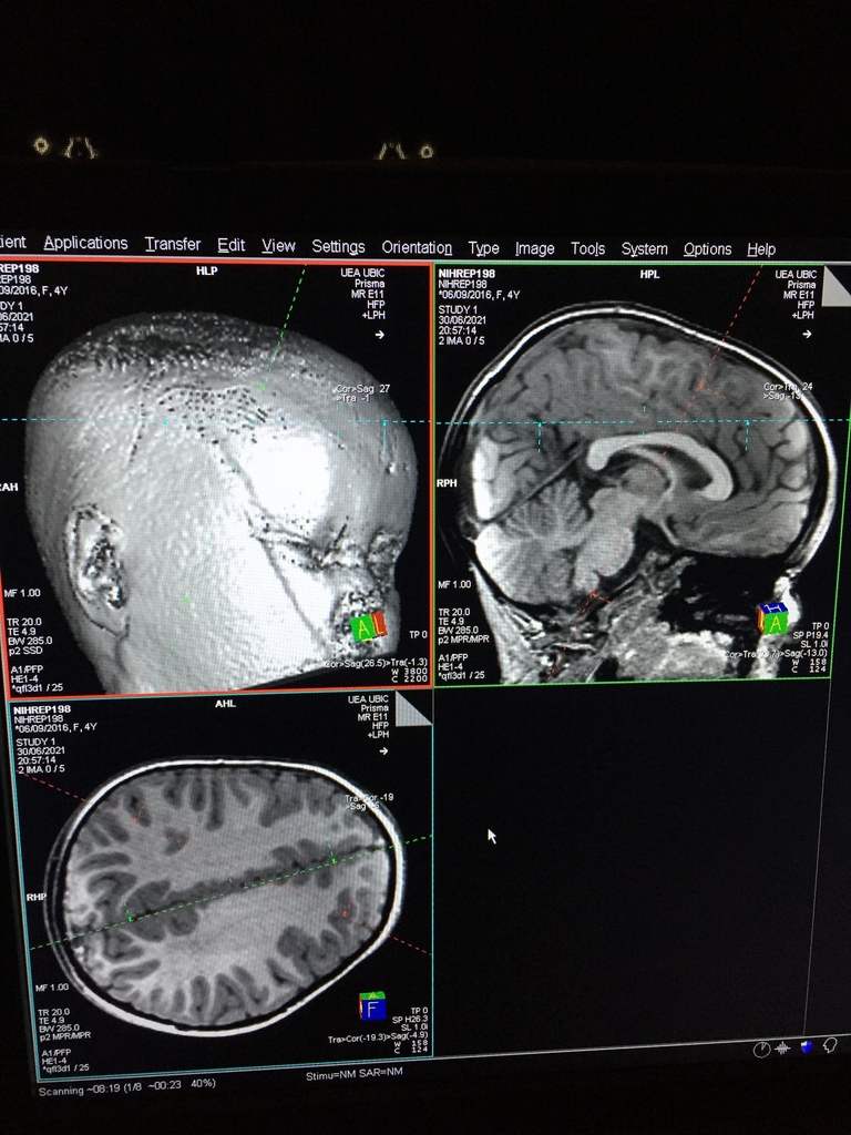 잠자는 동안 촬영한 유아 뇌 MRI 사진