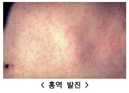 전세계 홍역 유행…해외여행 후 3주내 발열·발진 시 진료받아야